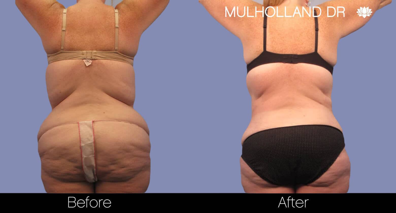 Body Lift - Before and After Gallery – Photo 4