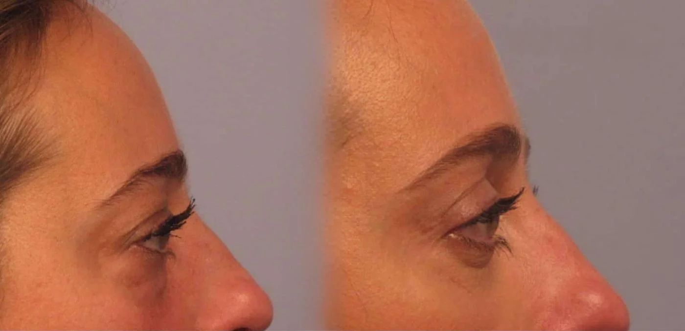 Blepharoplasty - Before and After Gallery – Photo 4