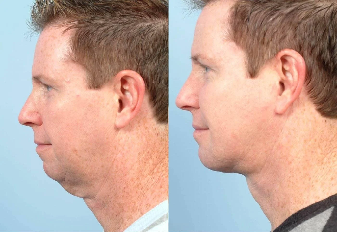 Male Neck Lift - Before and After Gallery – Photo 4
