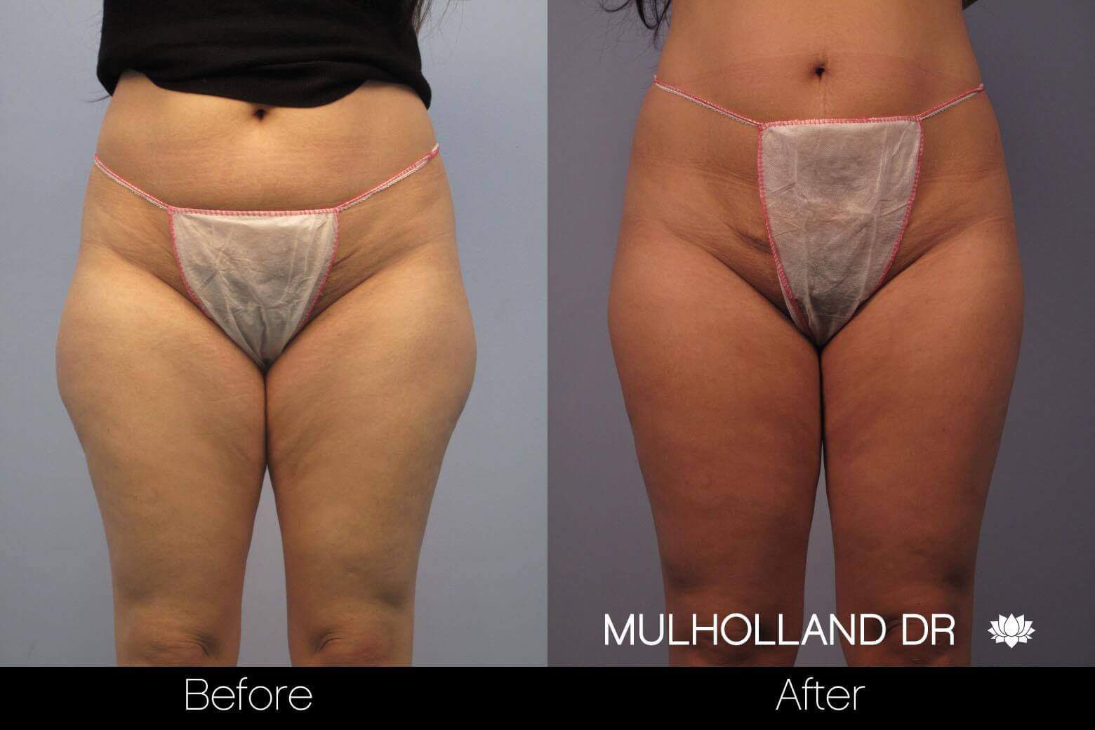 BodyTite Liposuction - Before and After Gallery - Patient Photo 52