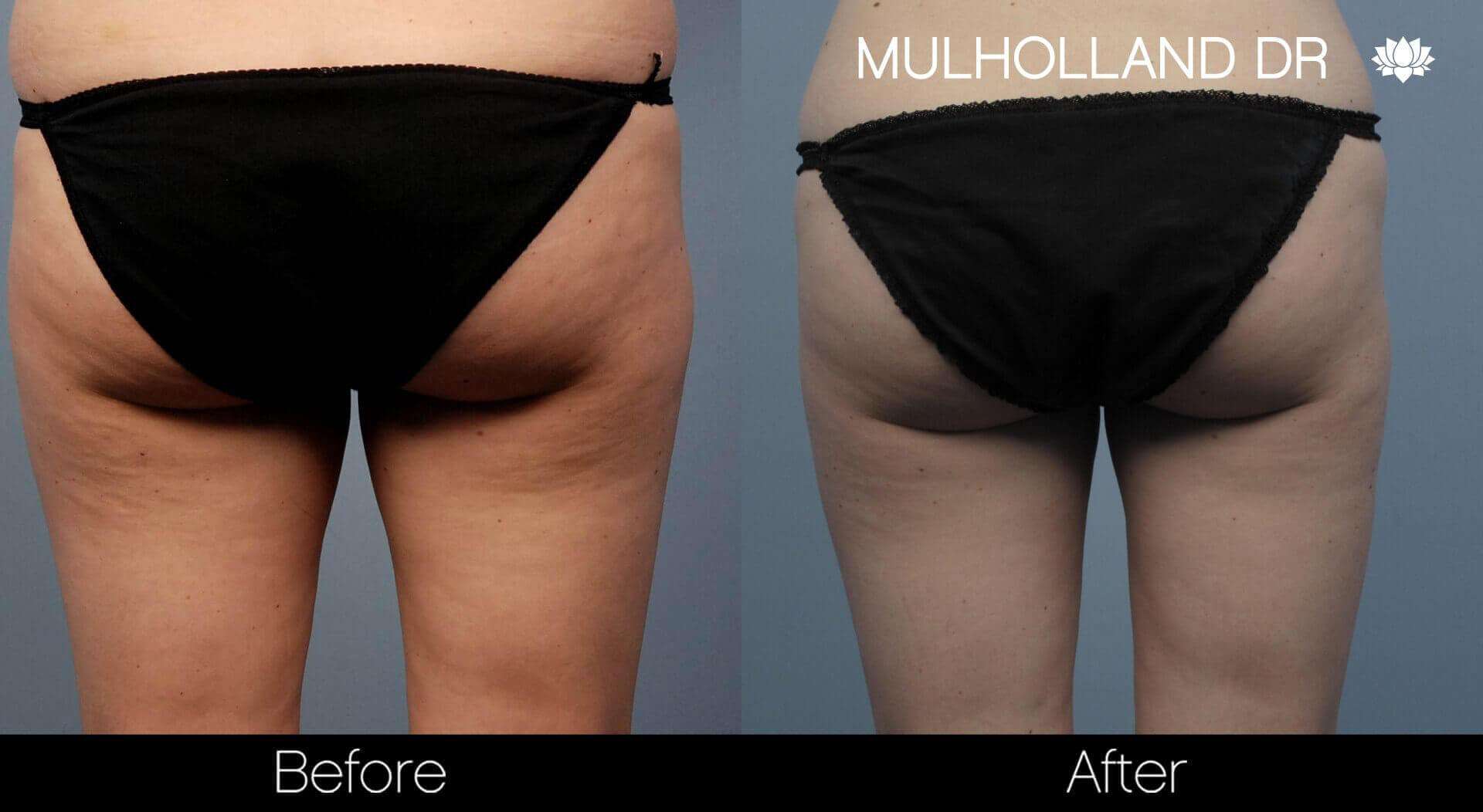 BodyTite Liposuction - Before and After Gallery - Patient Photo 52