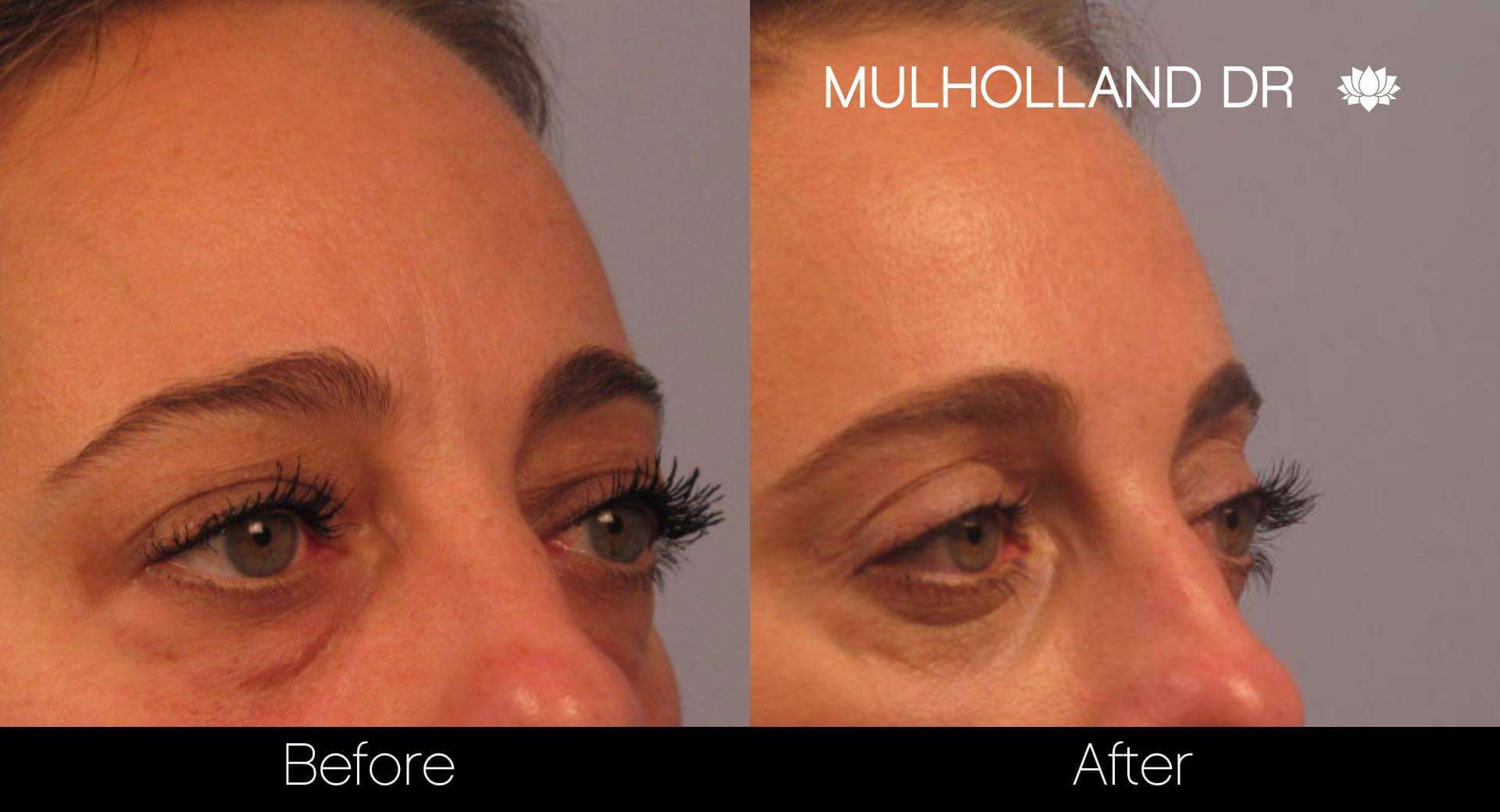 Blepharoplasty - Before and After Gallery – Photo 5