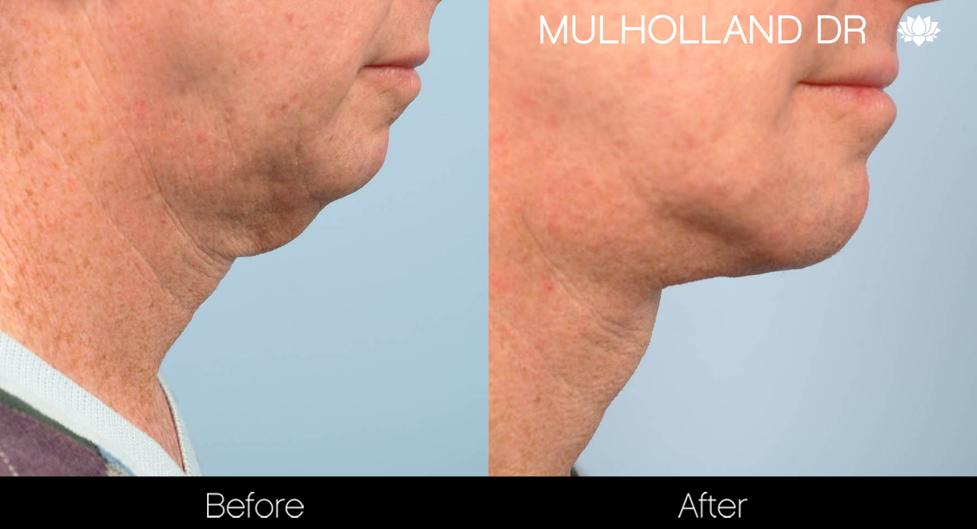 Male Neck Lift - Before and After Gallery – Photo 5