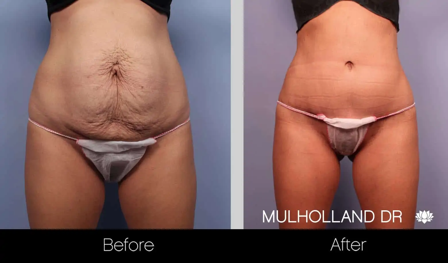 Mini Tummy Tuck - Before and After Gallery - Patient Photo 18