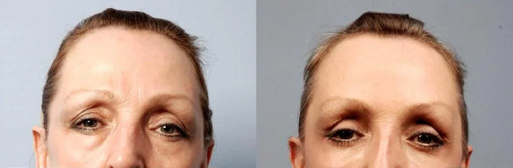 Blepharoplasty - Before and After Gallery – Photo 6