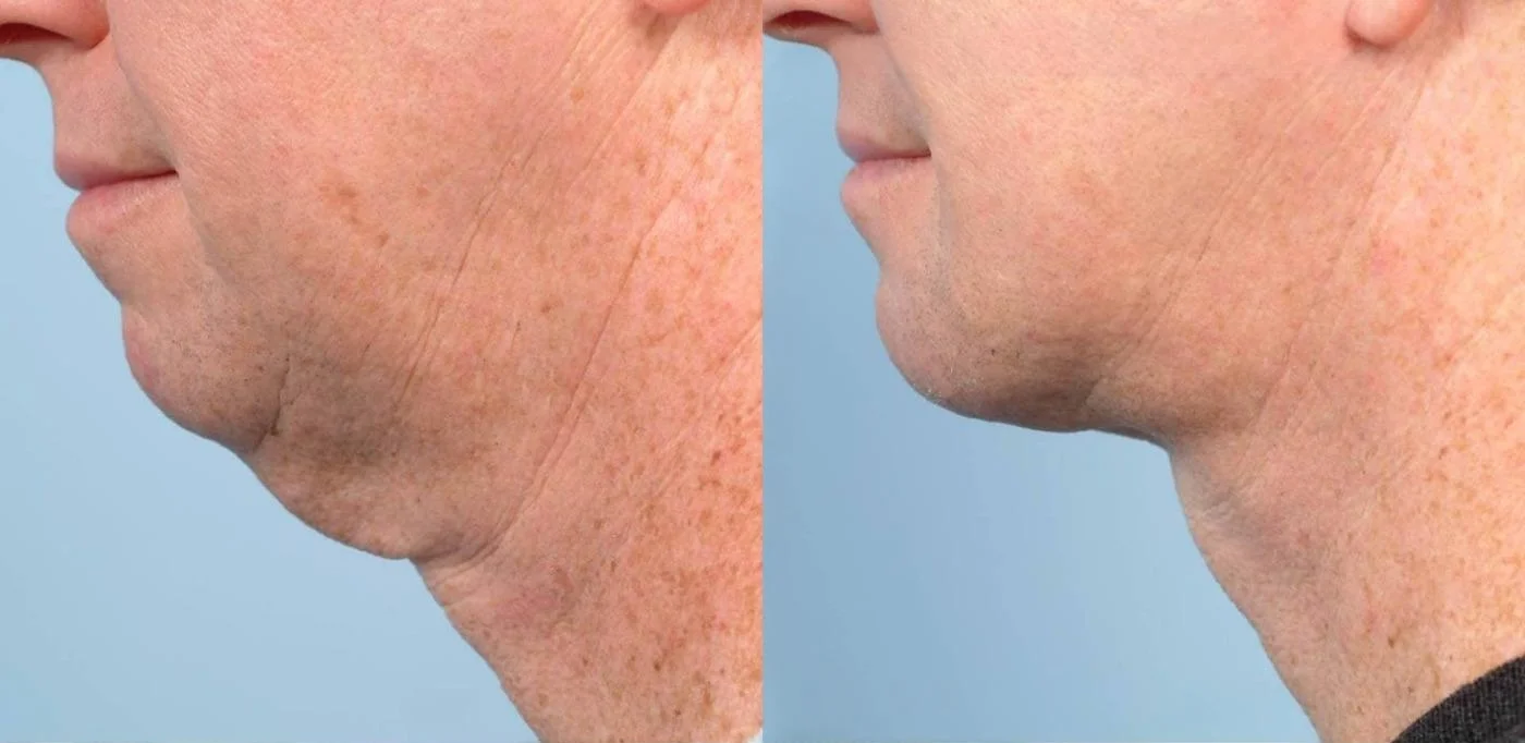 Male Neck Lift - Before and After Gallery – Photo 6