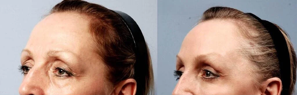 Blepharoplasty - Before and After Gallery – Photo 7