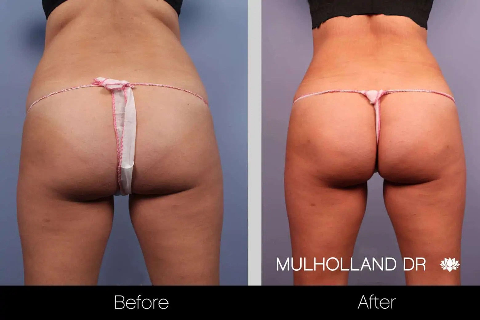 Mini Tummy Tuck - Before and After Gallery - Patient Photo 17