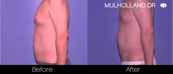 Liposuction -Before and After Gallery - Patient Photo 82