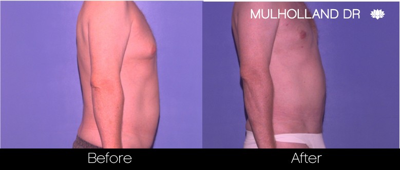 Liposuction -Before and After Gallery - Patient Photo 83