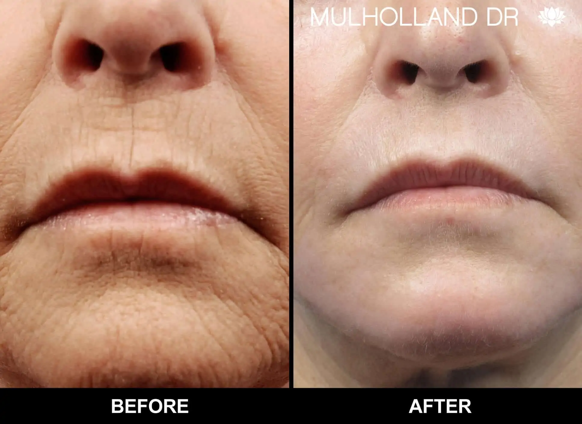 Facetite - Before and After Gallery - Patient Photo 85