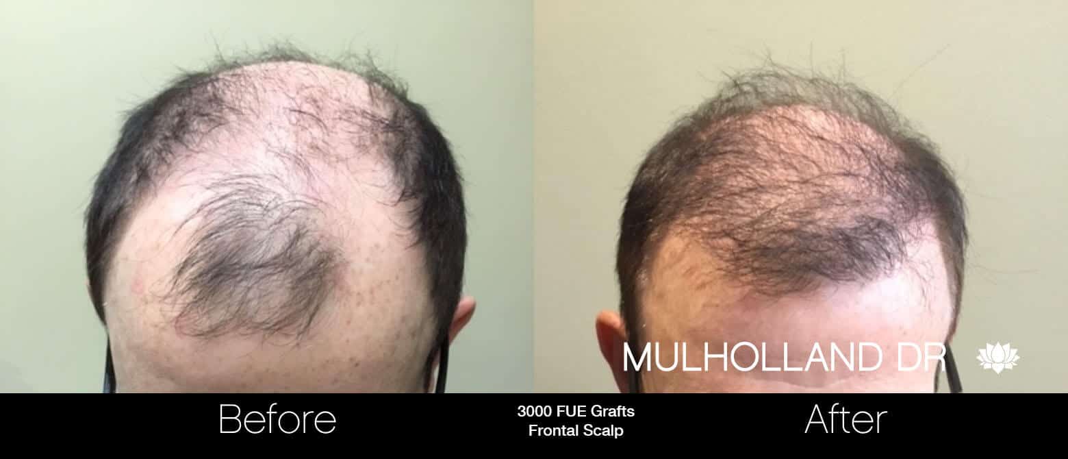 Artas Hair Transplant - Before and After Gallery - Patient Photo 84