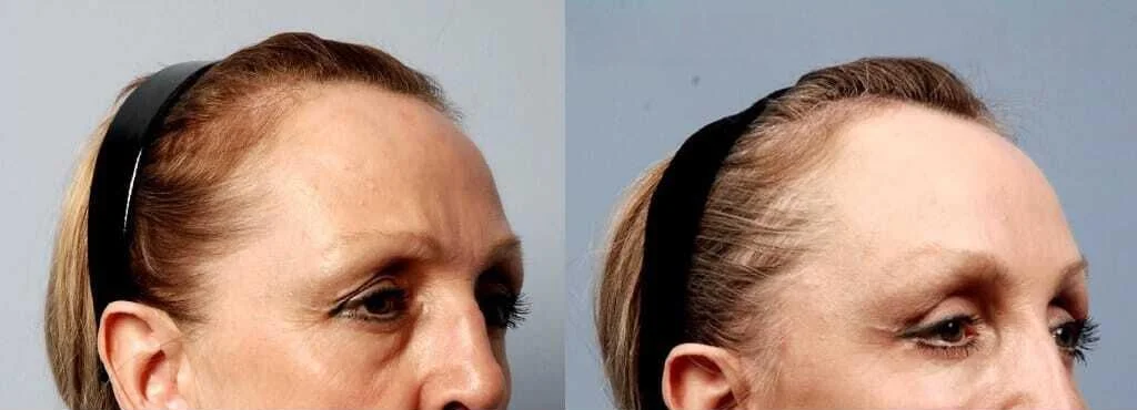 Blepharoplasty - Before and After Gallery – Photo 8