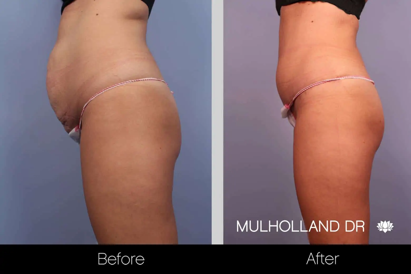 Mini Tummy Tuck - Before and After Gallery - Patient Photo 16