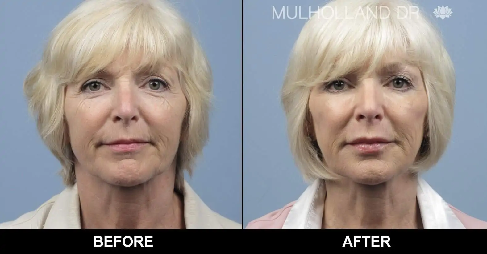 Fractional CO2 - Before and After Gallery - Patient Photo 8