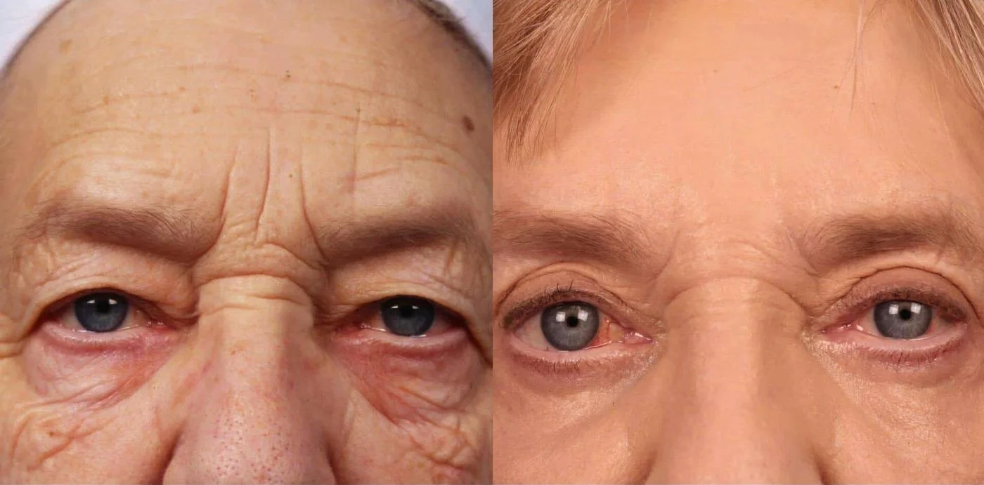 Blepharoplasty - Before and After Gallery – Photo 9