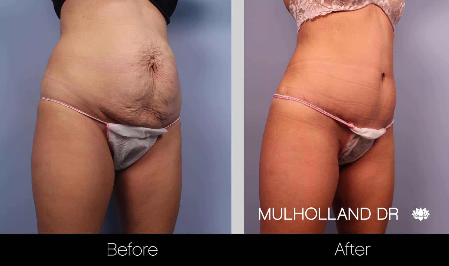 Liposuction -Before and After Gallery - Patient Photo 10