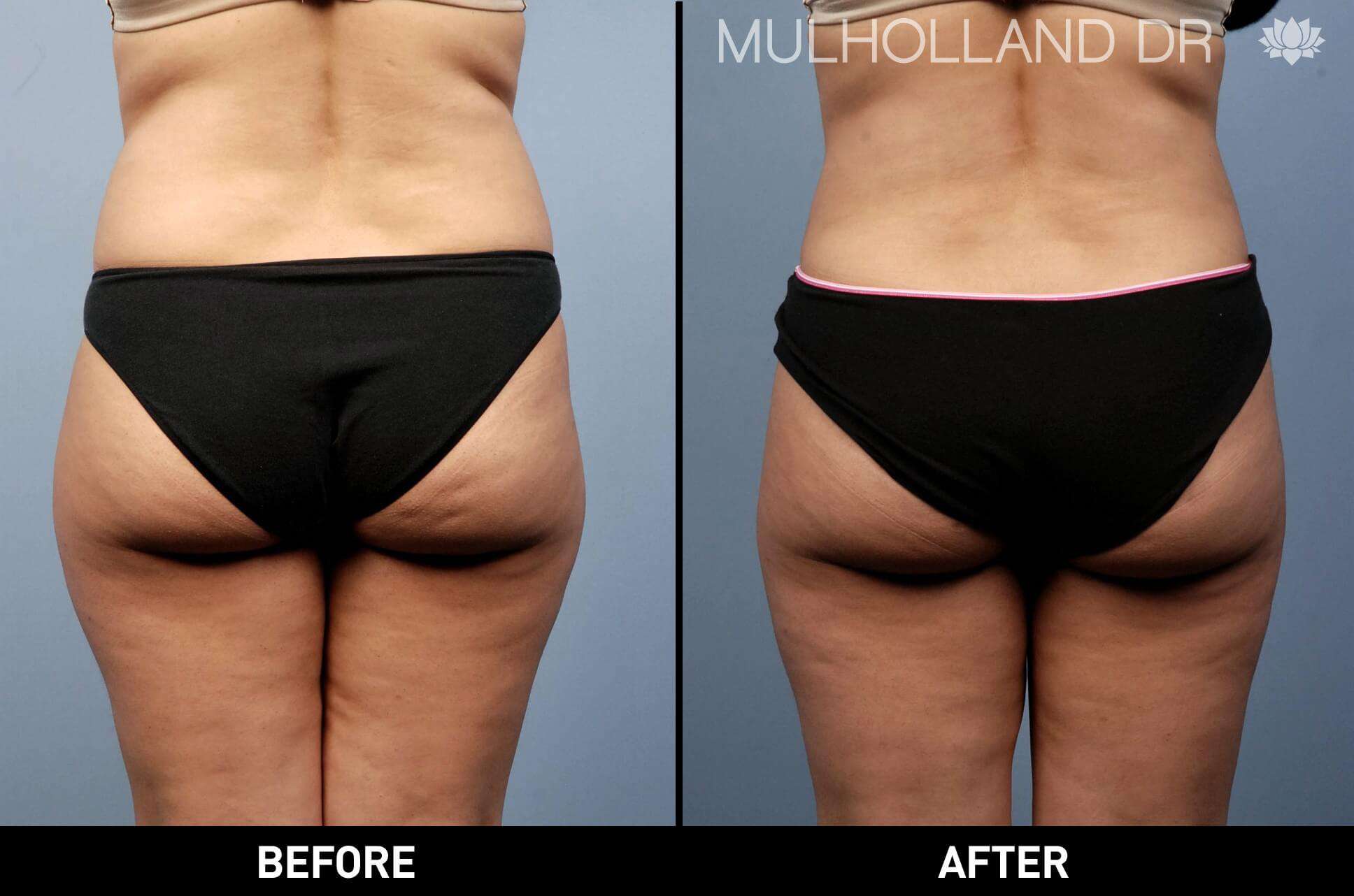 Liposuction -Before and After Gallery - Patient Photo 16