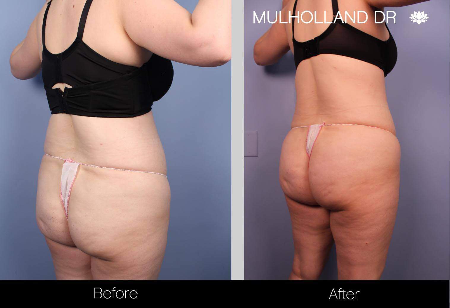 Liposuction -Before and After Gallery - Patient Photo 30