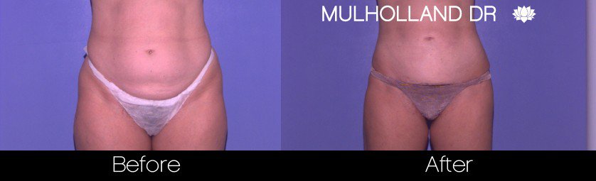 Liposuction -Before and After Gallery - Patient Photo 35