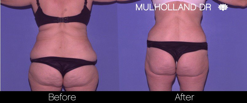 Liposuction -Before and After Gallery - Patient Photo 46