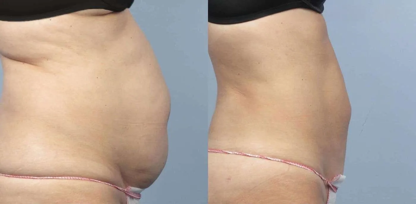 Liposuction -Before and After Gallery - Patient Photo 5