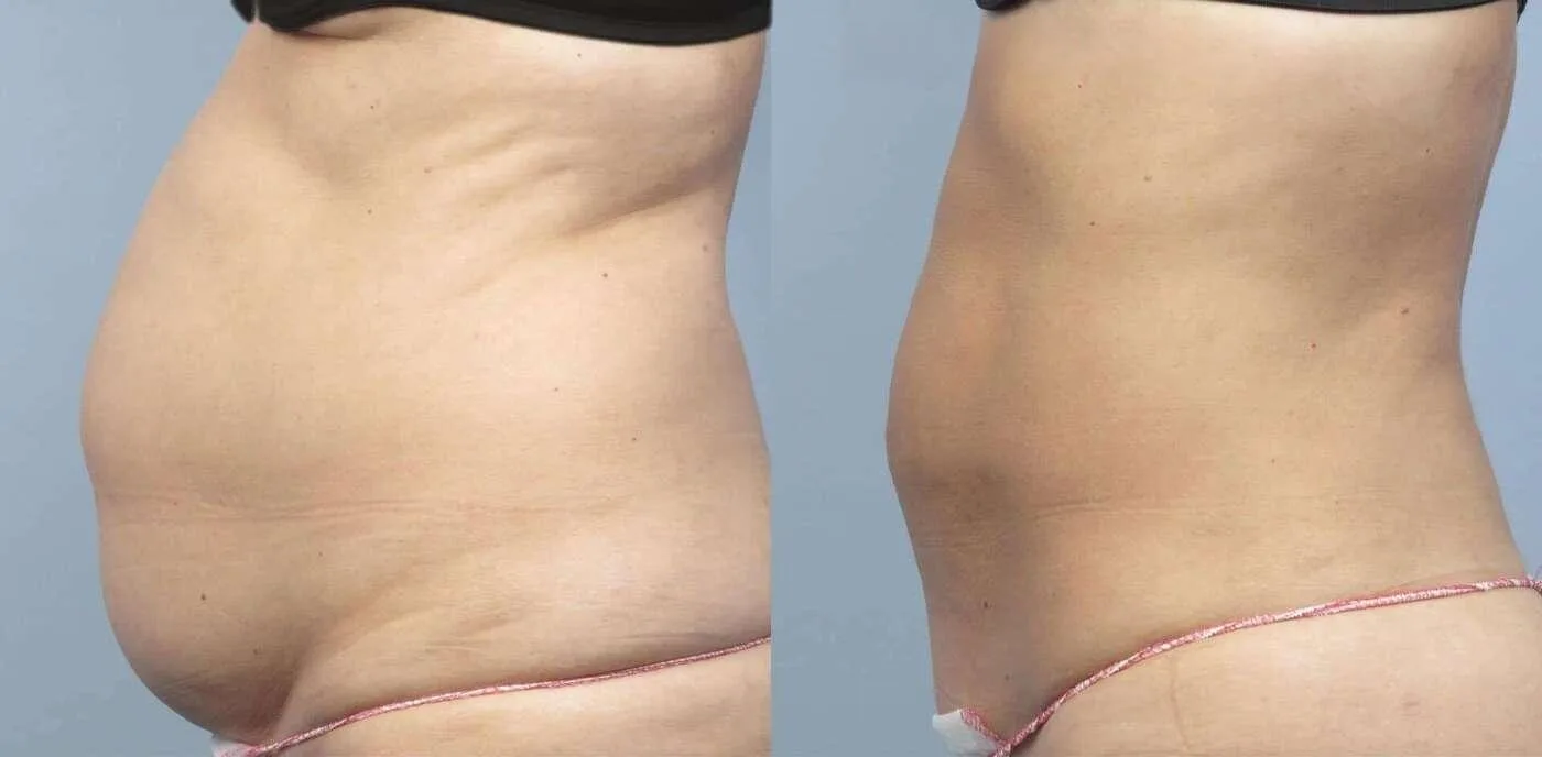 Liposuction -Before and After Gallery - Patient Photo 6