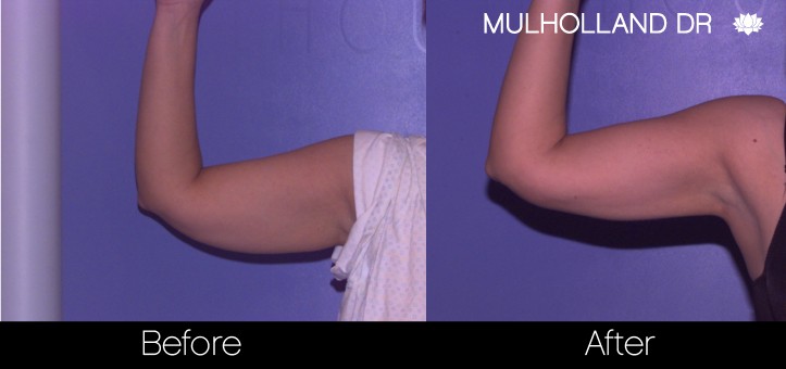 Liposuction -Before and After Gallery - Patient Photo 70