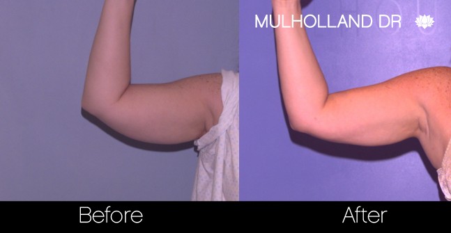 Liposuction -Before and After Gallery - Patient Photo 74