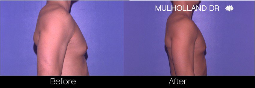 Liposuction -Before and After Gallery - Patient Photo 75