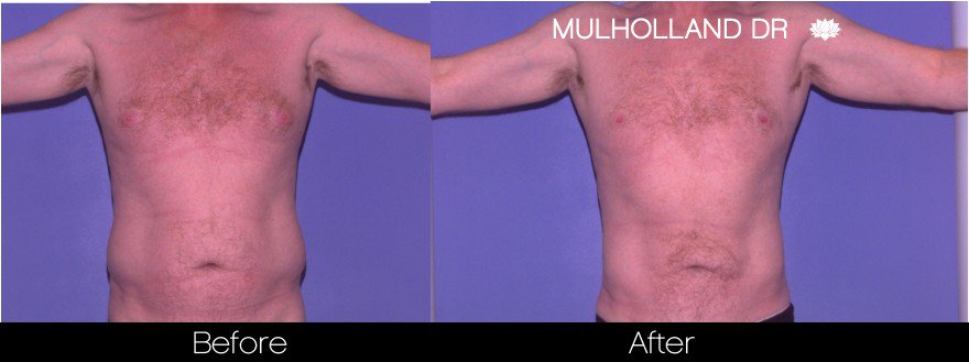 Liposuction -Before and After Gallery - Patient Photo 85