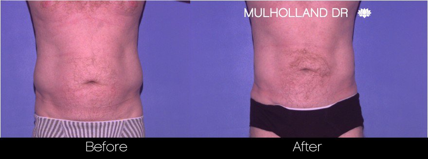 Liposuction -Before and After Gallery - Patient Photo 86