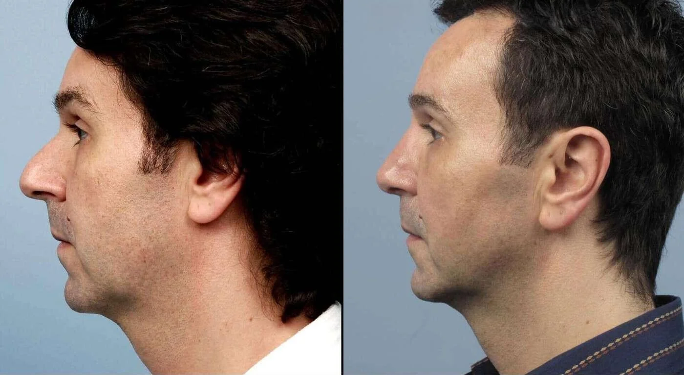 Male Rhinoplasty - Before and After Gallery - Patient Photo 1
