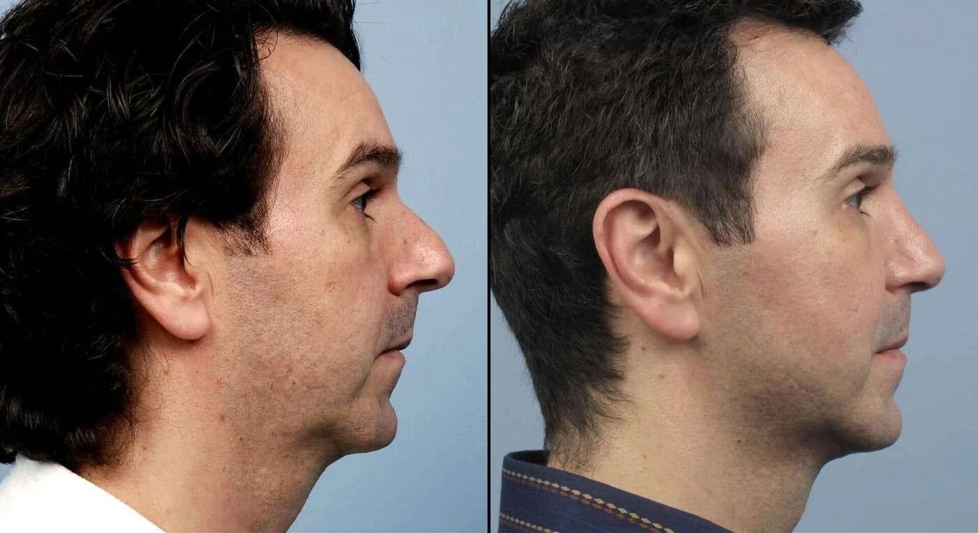 Male Rhinoplasty - Before and After Gallery - Patient Photo 2