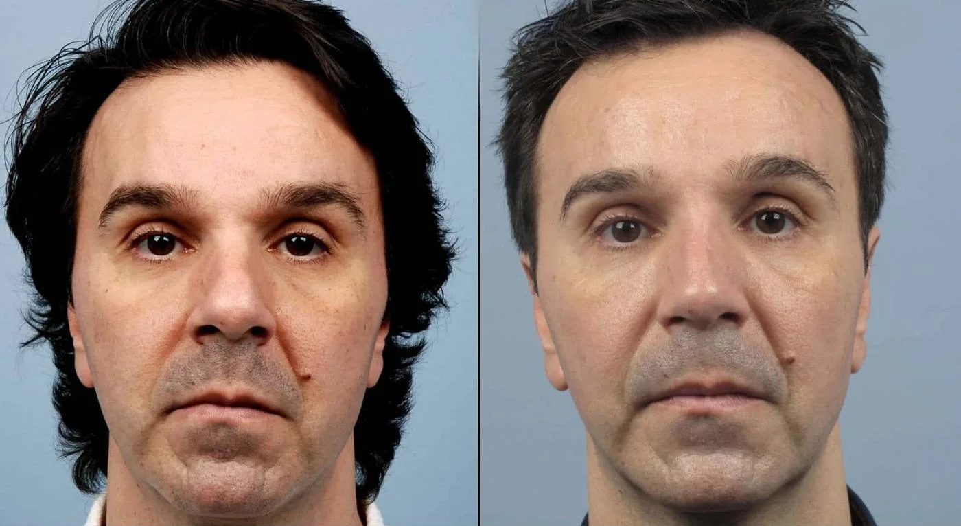 Male Rhinoplasty - Before and After Gallery - Patient Photo 3