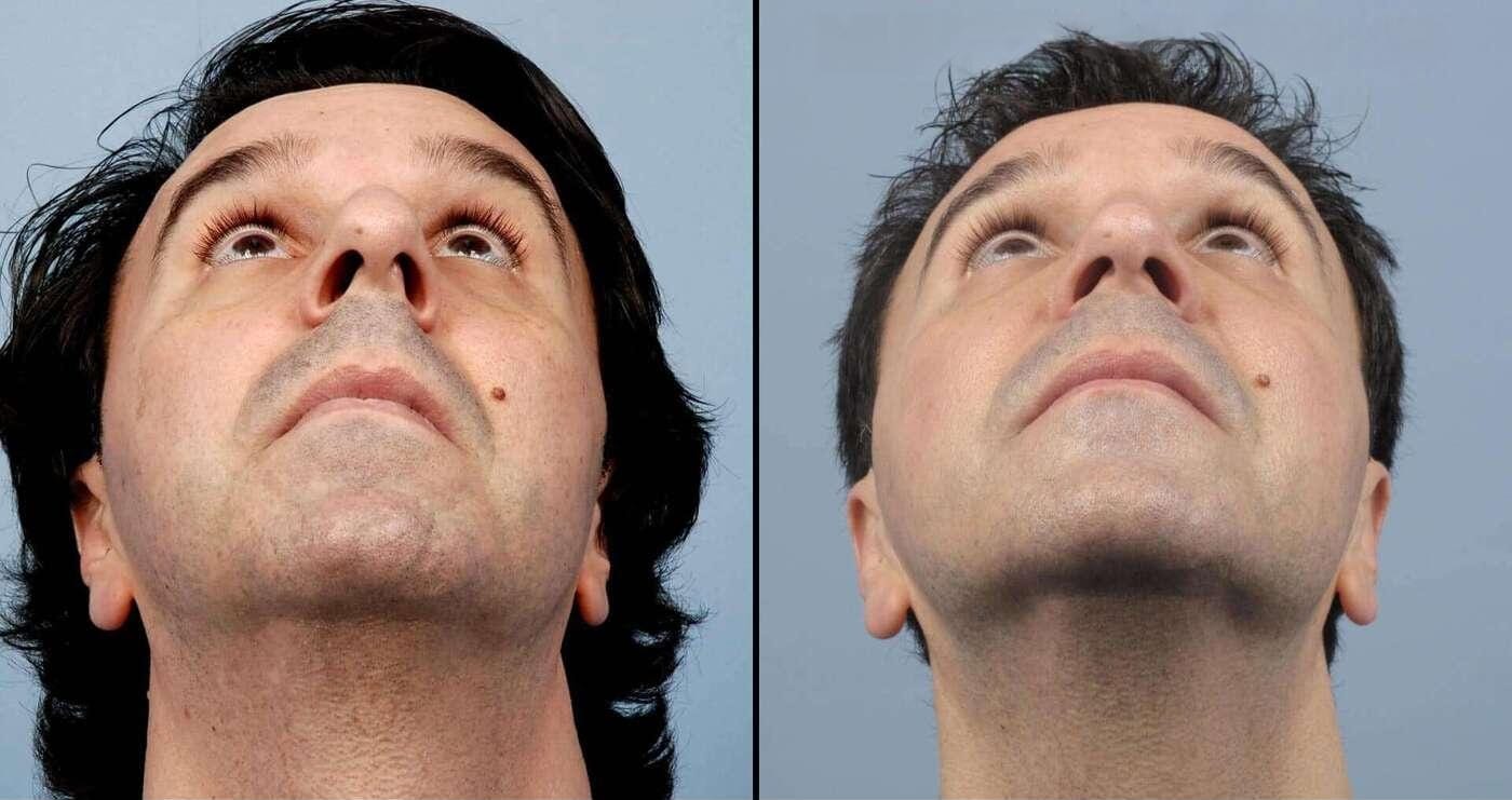 Male Rhinoplasty Before After Photo Gallery TPS