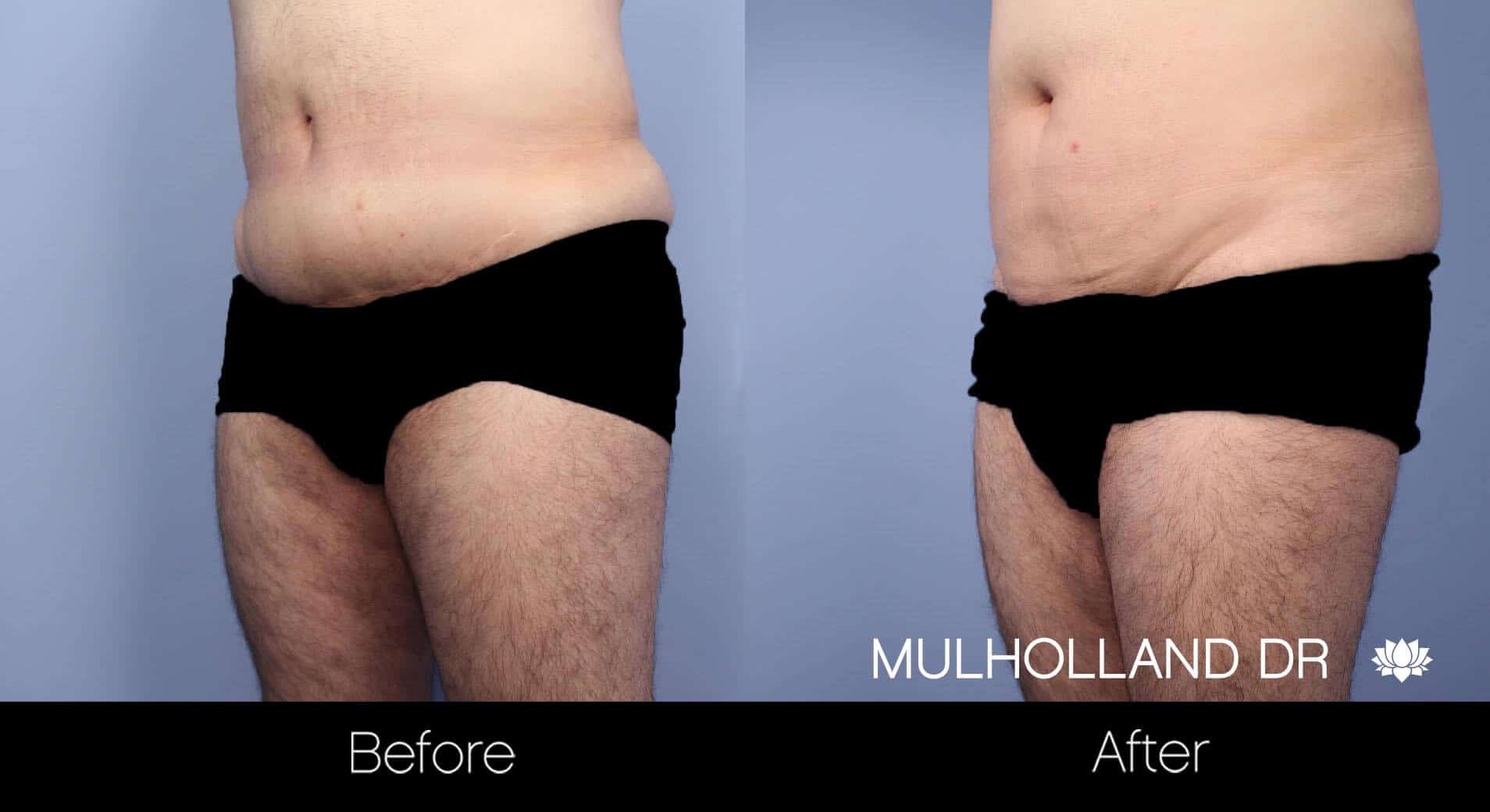 Male Tummy Tuck - Before and After Gallery - Patient Photo 14