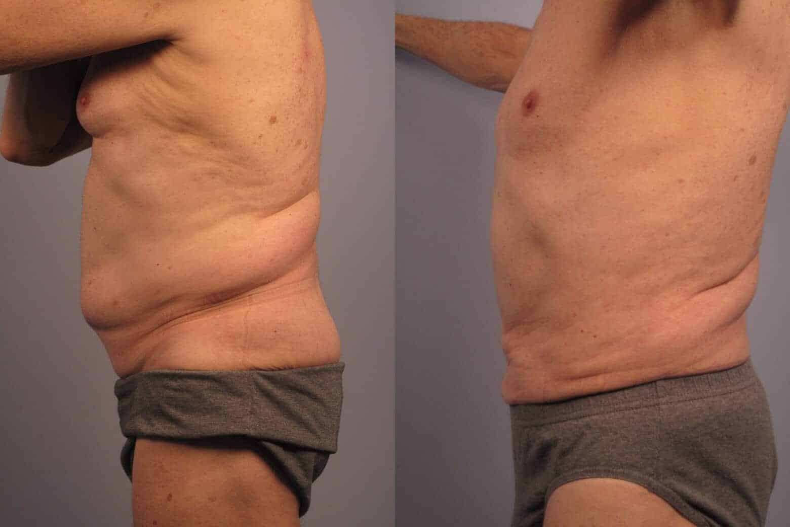 Male Tummy Tuck - Before and After Gallery - Patient Photo 18