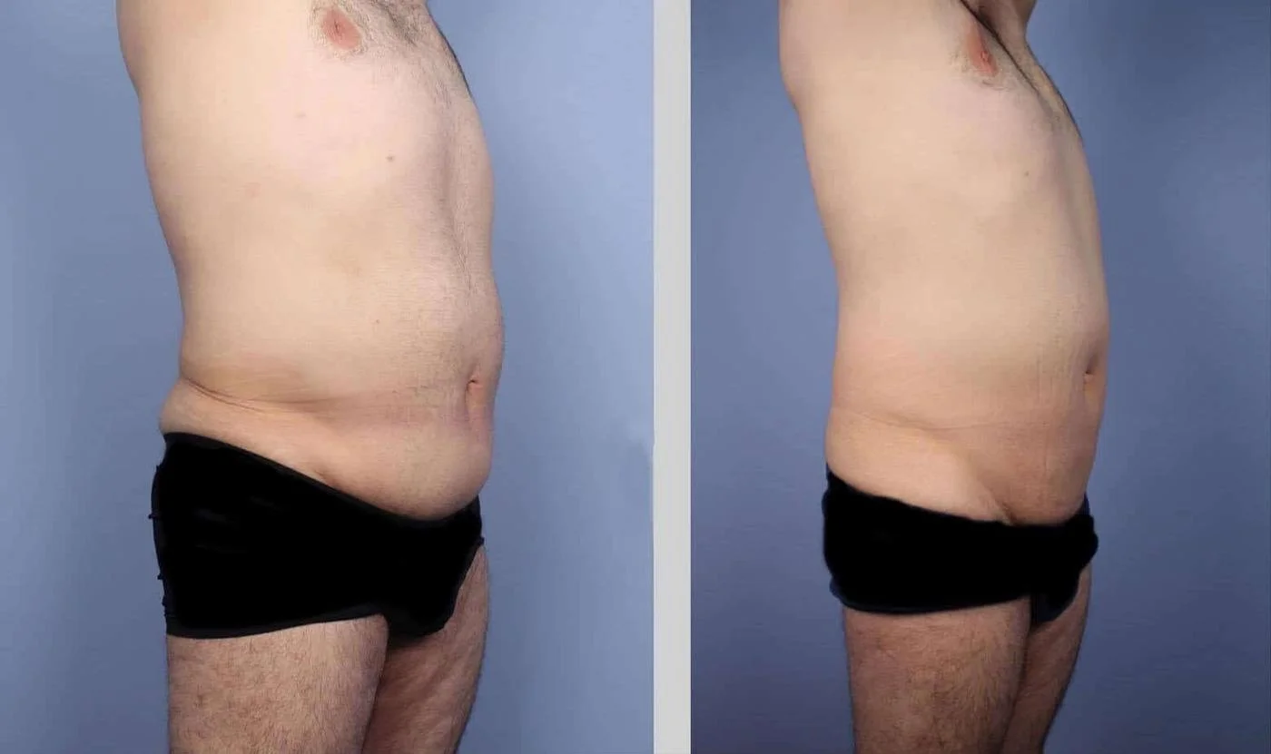 tirzepatide before surgery Holding Metformin Surgery: When to Stop and Restart Zepbound GLP-1 Medication Before Plastic