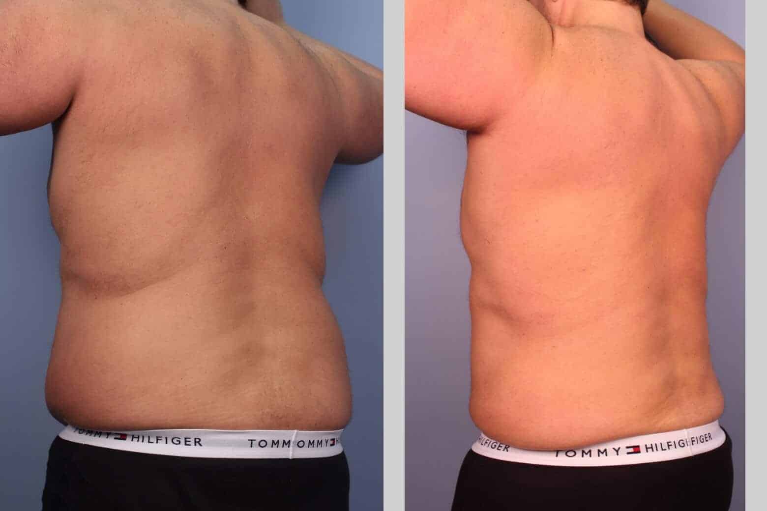 male tummy tuck recovery