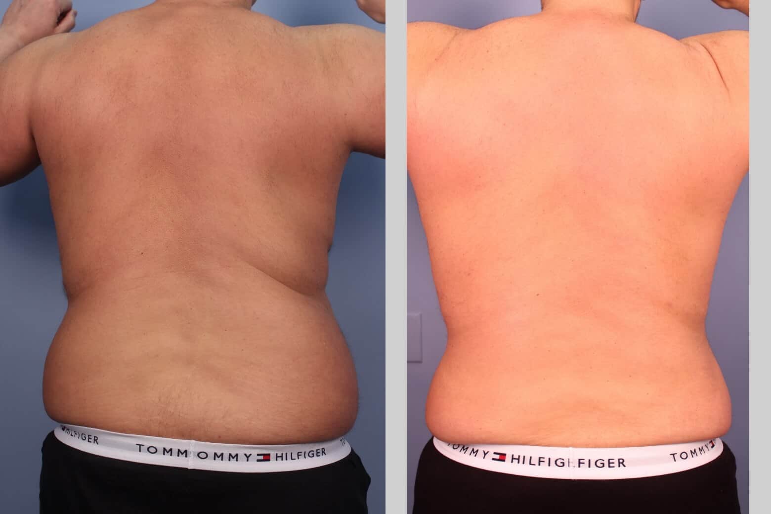 Male Tummy Tuck - Before and After Gallery - Patient Photo 28