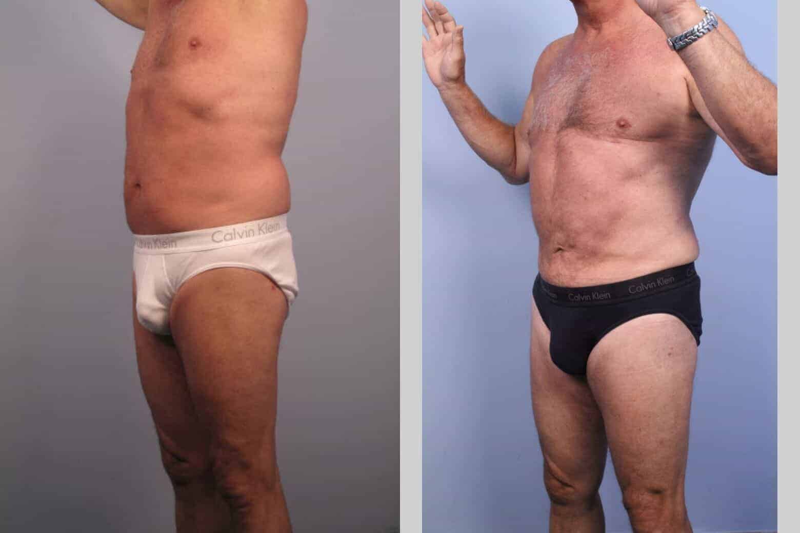 Male Tummy Tuck - Before and After Gallery - Patient Photo 35