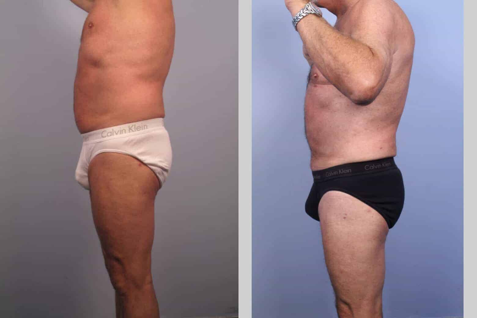 Male Tummy Tuck - Before and After Gallery - Patient Photo 36