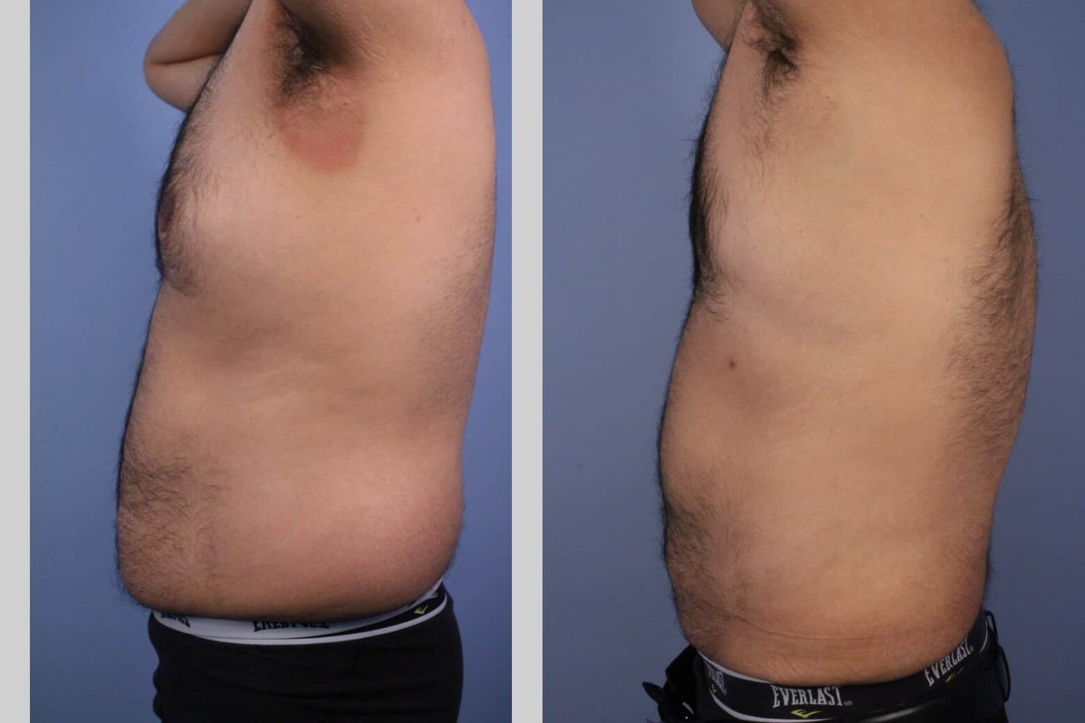 male tummy tuck recovery