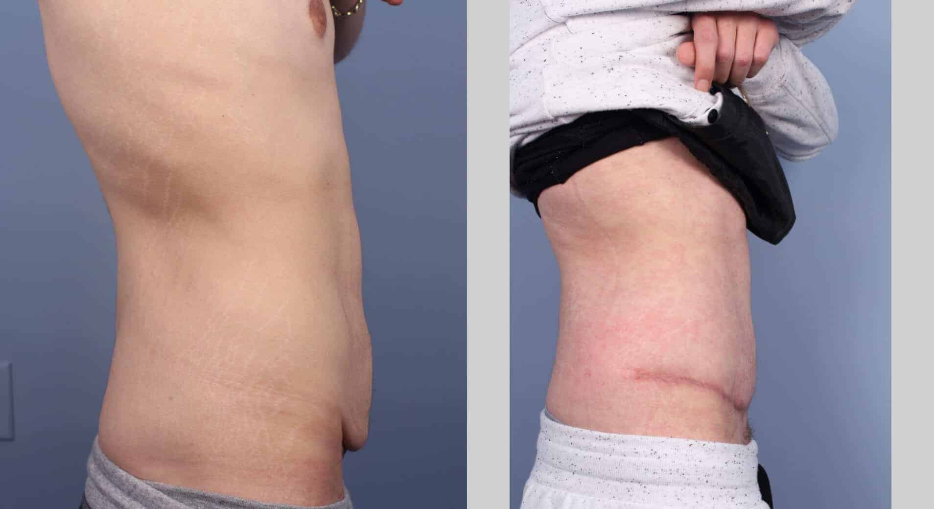 before and after tummy tuck results
