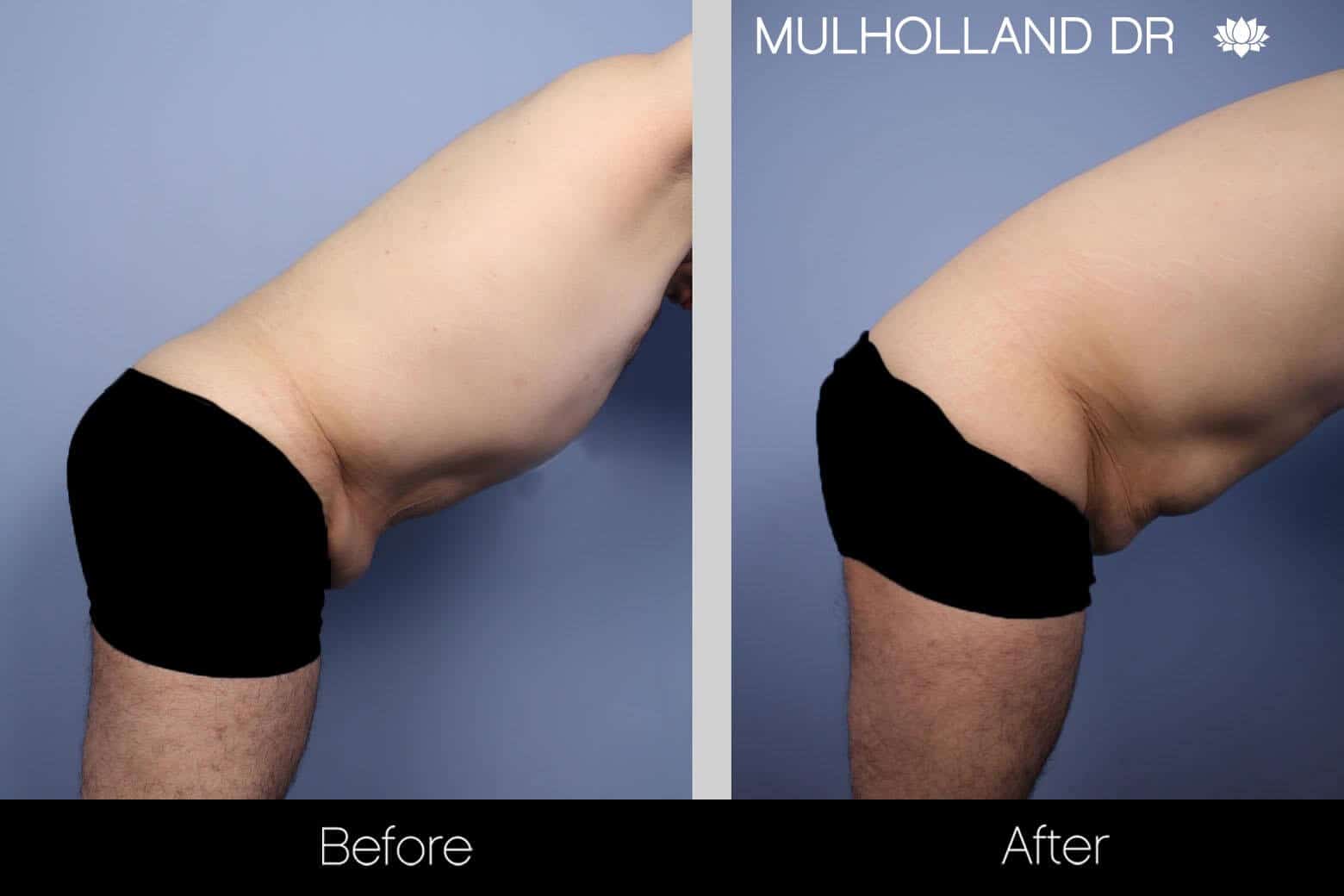 Male Tummy Tuck - Before and After Gallery - Patient Photo 8