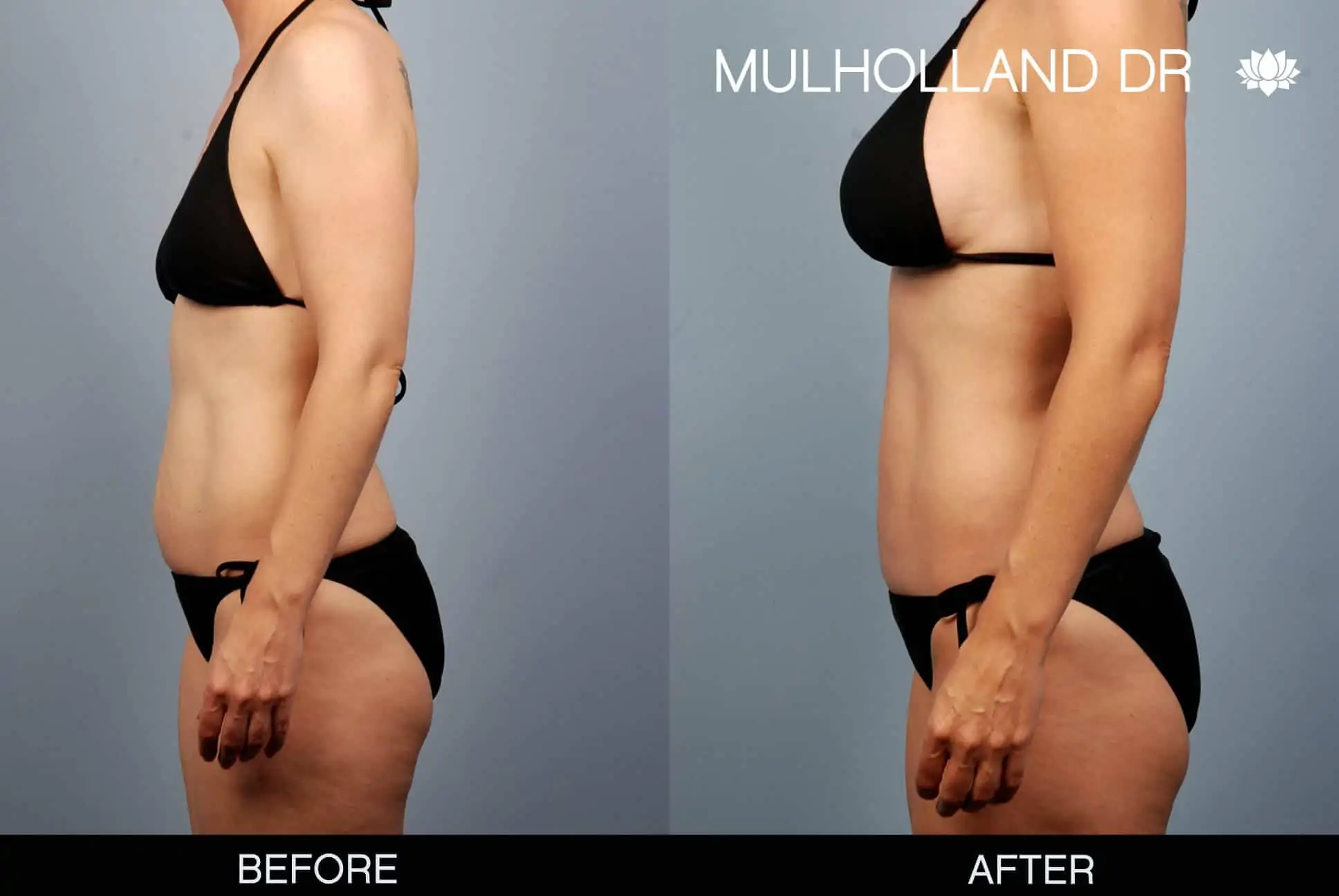 Mommy Makeover -Before and After Gallery - Patient Photo 1