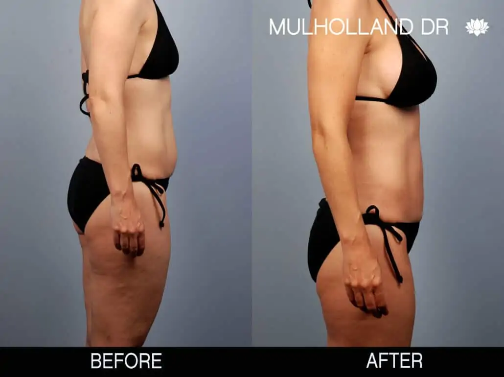 Mommy Makeover -Before and After Gallery - Patient Photo 10