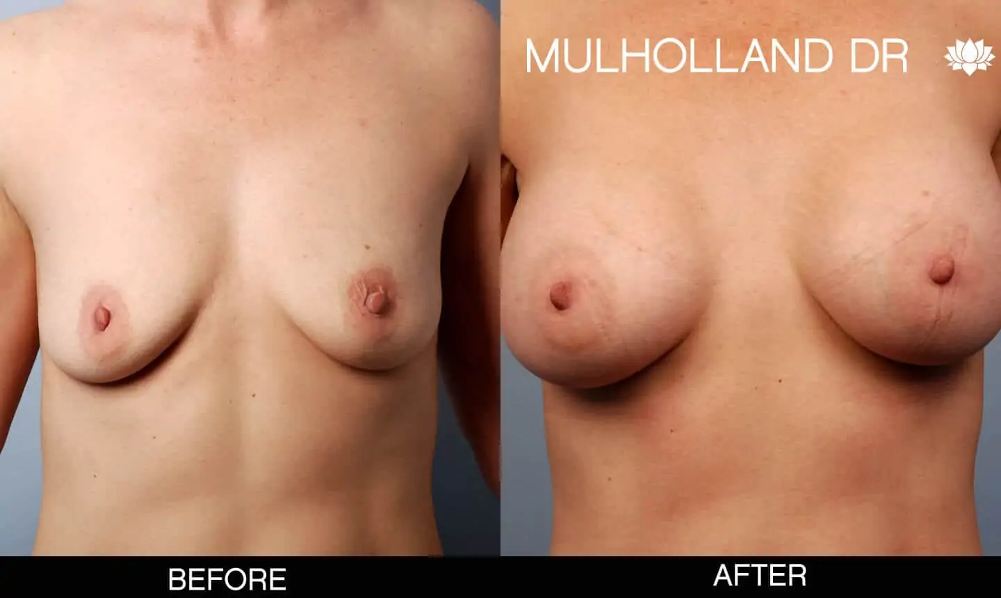 Mommy Makeover -Before and After Gallery - Patient Photo 13