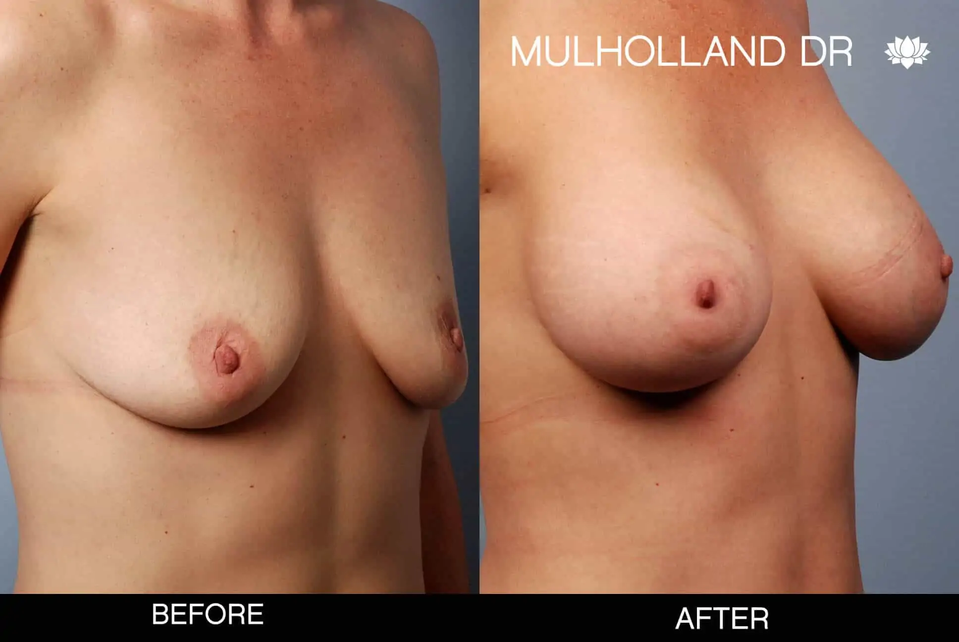 Mommy Makeover -Before and After Gallery - Patient Photo 14